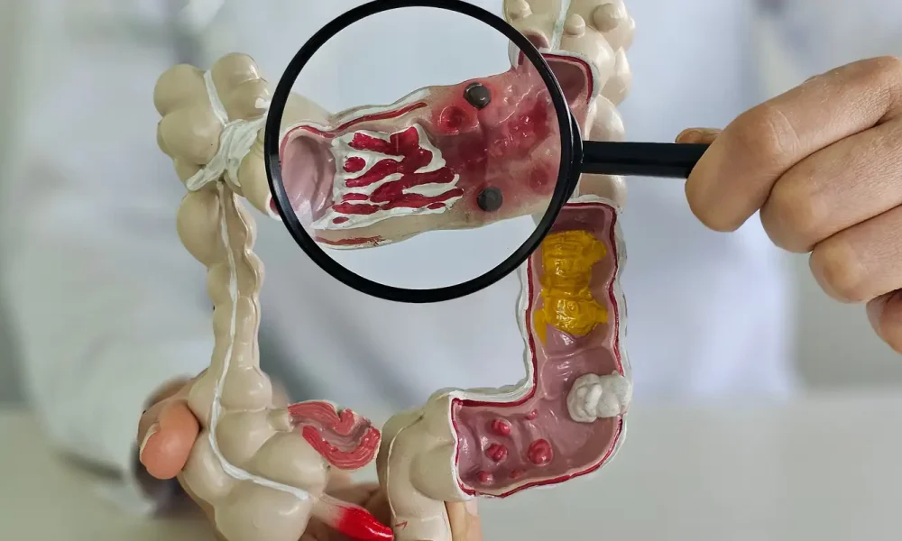 Doença inflamatória intestinal registra aumento de cinco vezes no Brasil em 13 anos