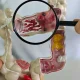 Doença inflamatória intestinal registra aumento de cinco vezes no Brasil em 13 anos