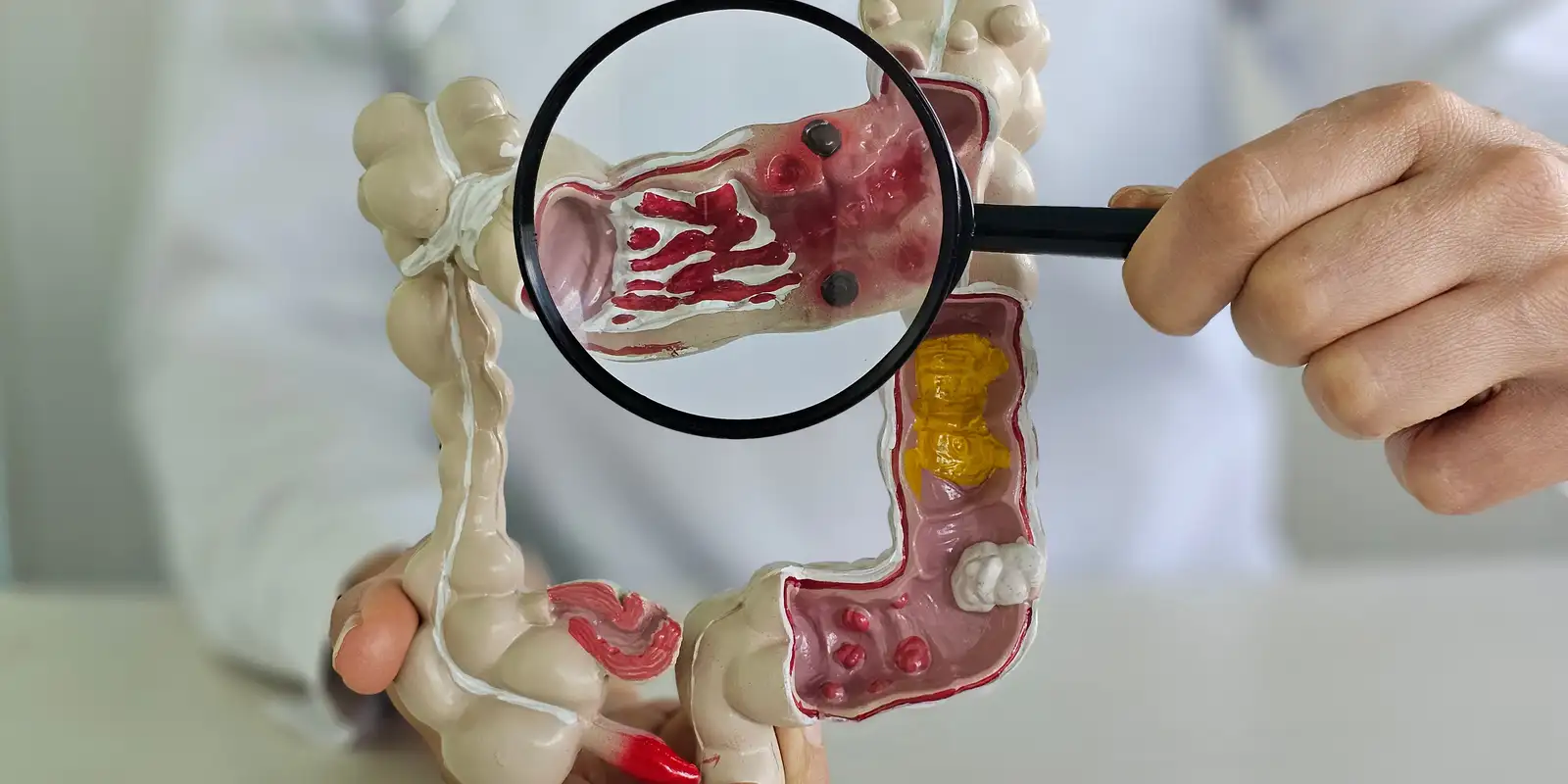 Doença inflamatória intestinal registra aumento de cinco vezes no Brasil em 13 anos