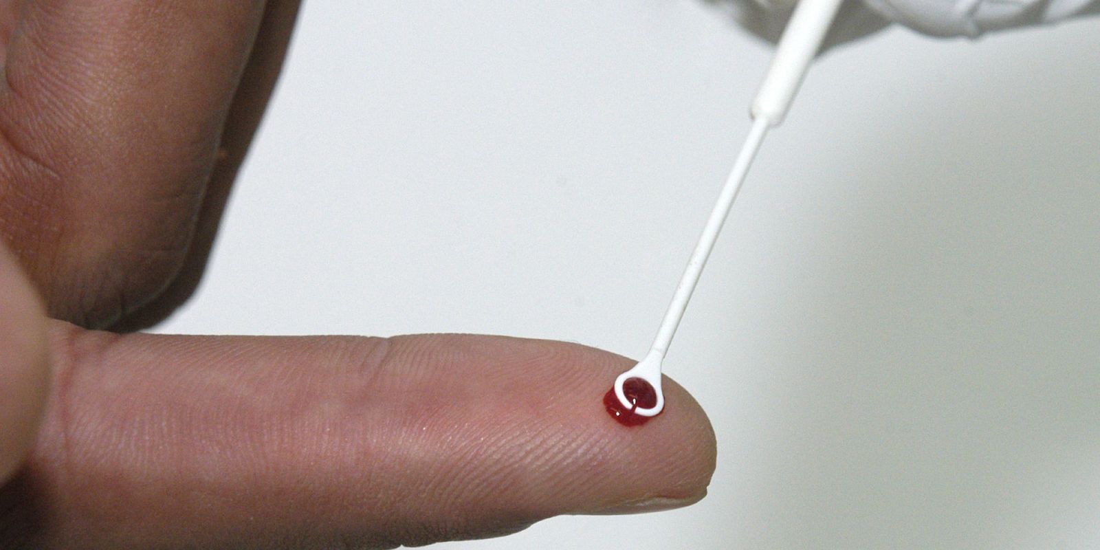 Fiji declara emergência nacional devido à alta taxa de HIV, com 1 caso a cada 60 pessoas